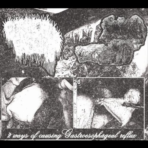 eosinophilic-fasciitis